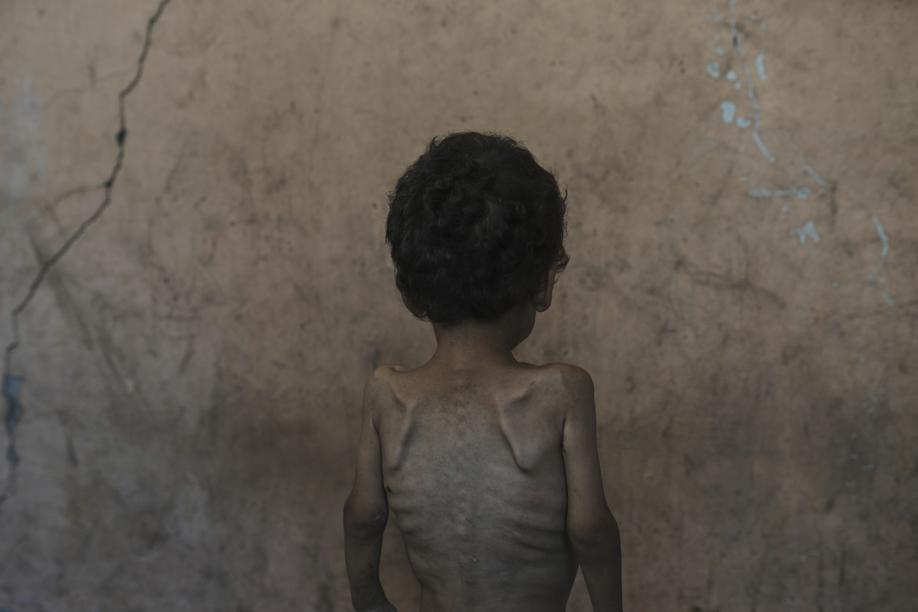 I bambini affamati di Gaza: il mondo è pronto ad intervenire?