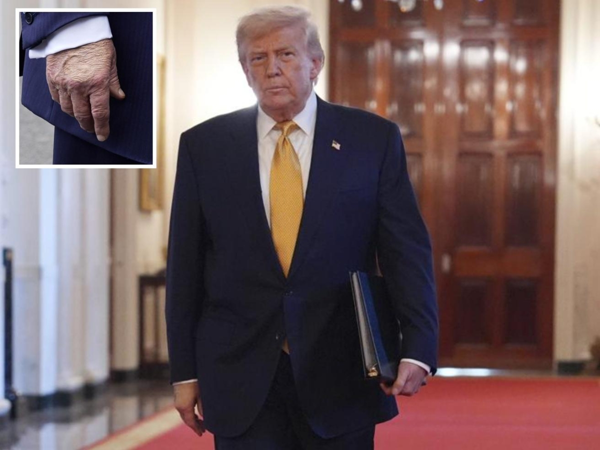 Lividi sulla mano di Trump, la Casa Bianca spiega: «È una comune insufficienza venosa»