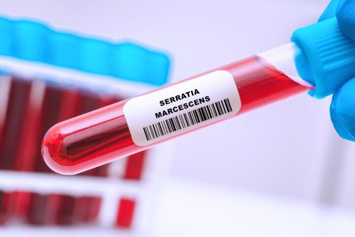 Serratia marcescens: come si diffonde in ospedale, sintomi e trattamenti