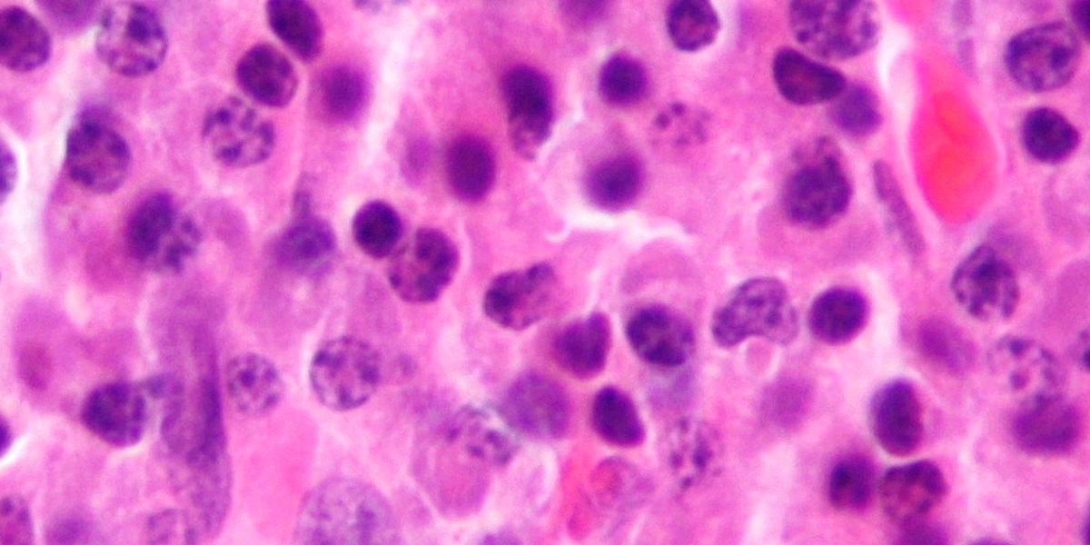 La giunta dell'Andalusia pubblica per errore dati sensibili di 23 pazienti malati di cancro