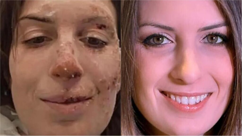 Eleonora Palmieri racconta il suo drammatico recupero dopo l'incendio di Crans-Montana