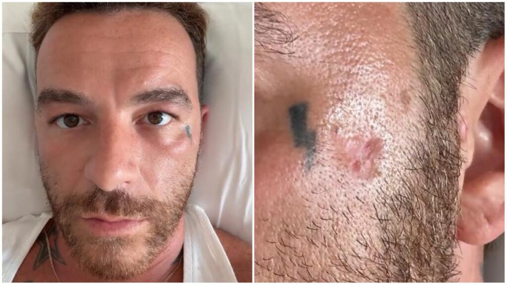 Salmo e le disinformazioni sul carcinoma basocellulare: l’Iss smonta le bufale sulle creme solari