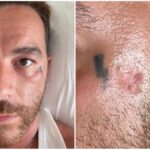 Salmo e le disinformazioni sul carcinoma basocellulare: l’Iss smonta le bufale sulle creme solari